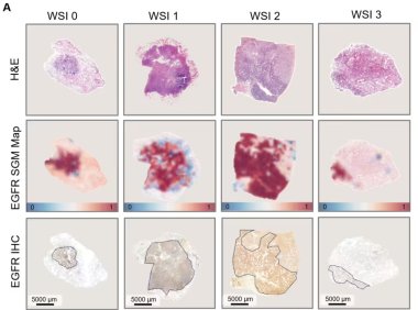 AI病理大模型实现肺癌基因突变快速预测 准确率高达78%至99%